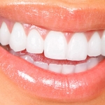sbiancamento denti